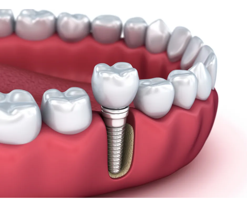 Dental implant model