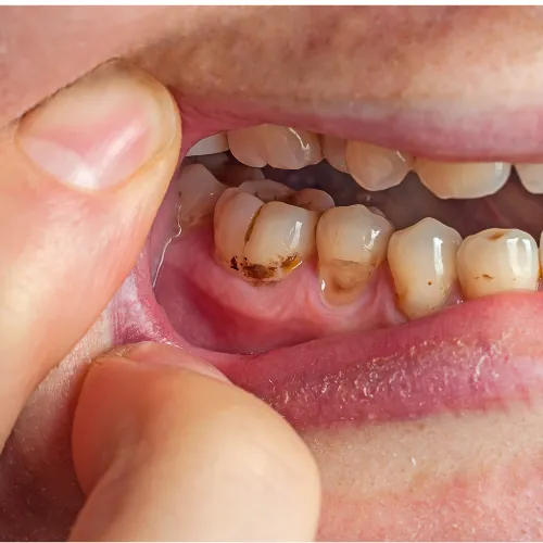 Patient experiencing tooth sensitivity