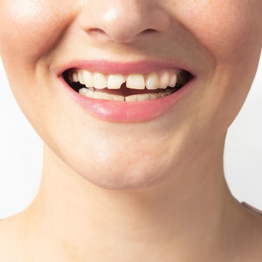 Broken tooth, emergency dental care